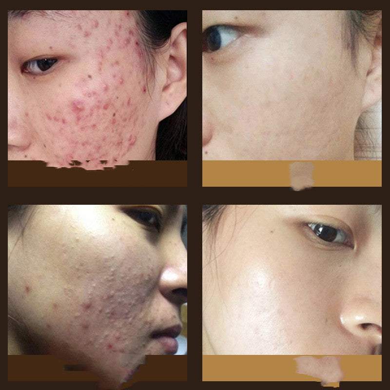 Ginseng herbal acne cream